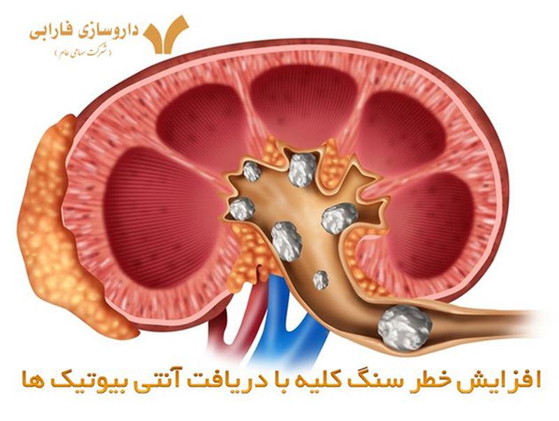 افزایش خطر سنگ کلیه با دریافت آنتی بیوتیک ها
