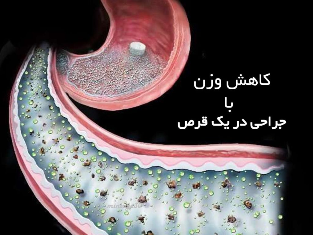 جراحی با یک قرص برای درمان دیابت نوع 2